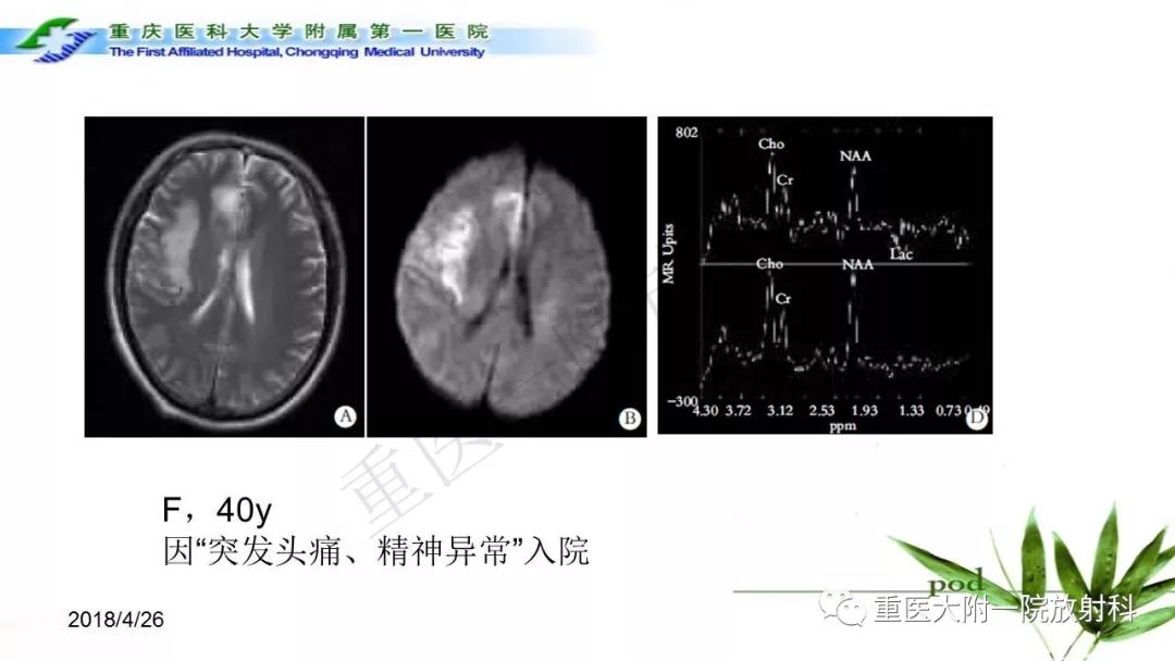 影像PPT - 【PPT】MELAS型线粒体脑肌病影像诊断及鉴别诊断-21