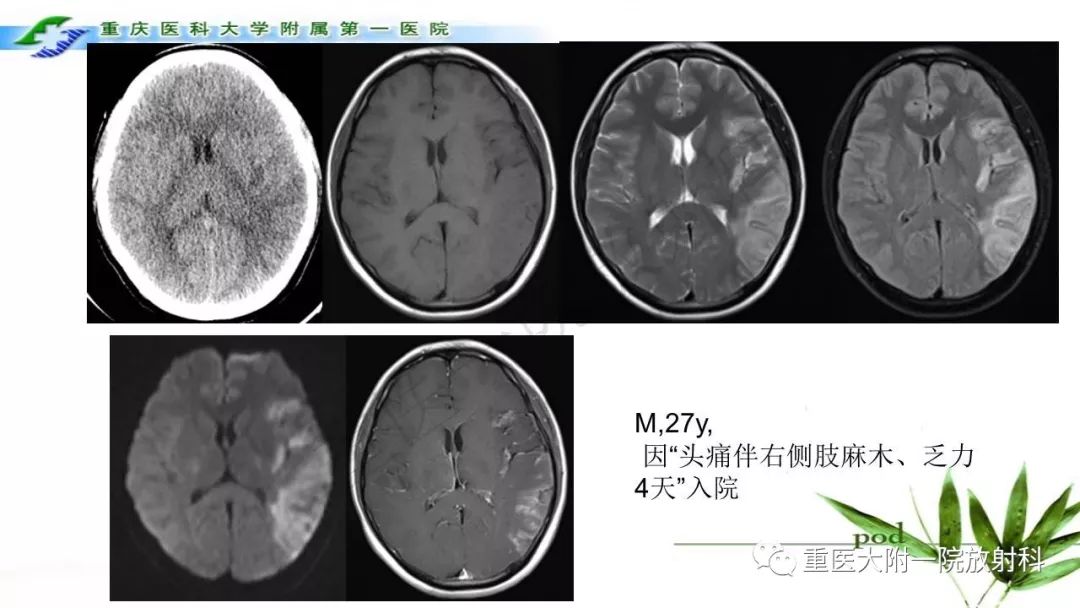 影像PPT - 【PPT】MELAS型线粒体脑肌病影像诊断及鉴别诊断-19