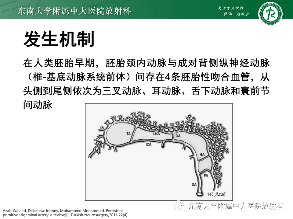 影像PPT - 【PPT】永存颈内—基底动脉吻合-6