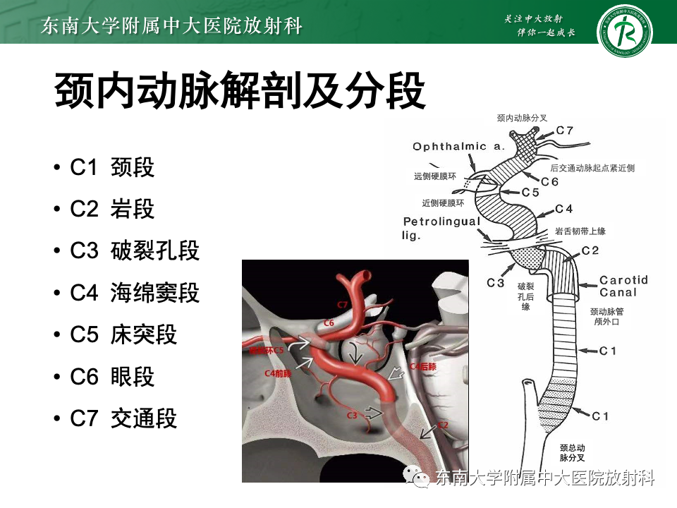 影像PPT - 【PPT】永存颈内—基底动脉吻合-9