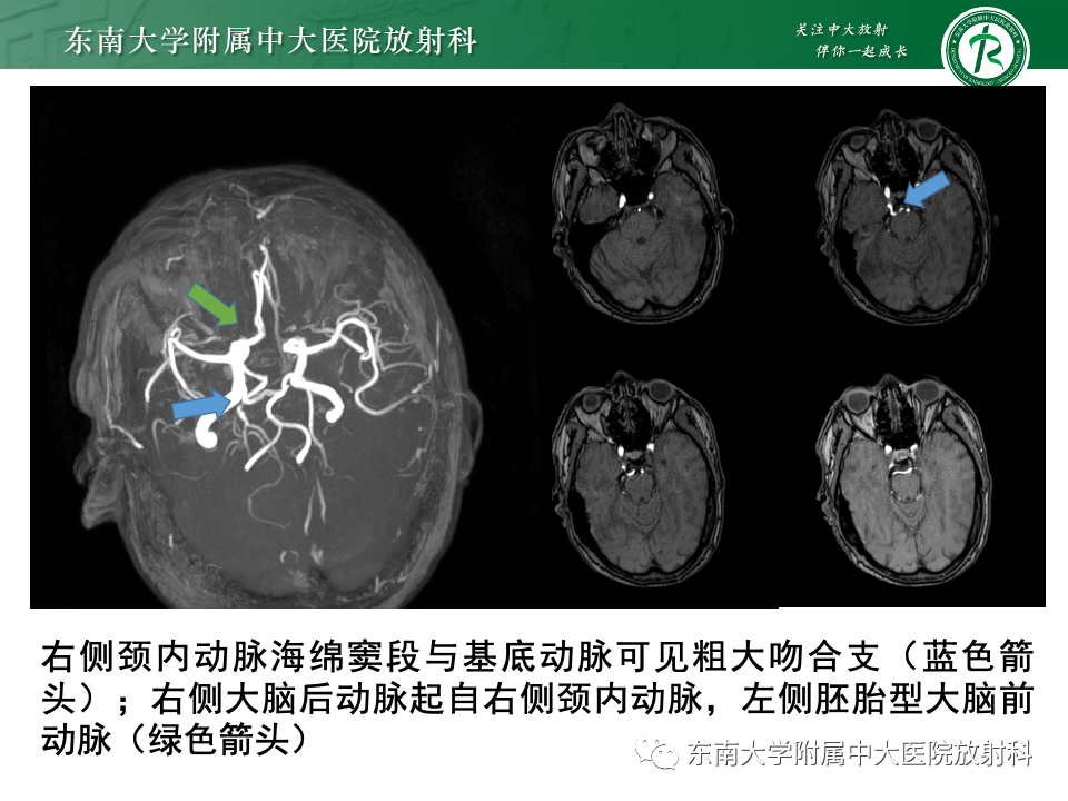 影像PPT - 【PPT】永存颈内—基底动脉吻合-3