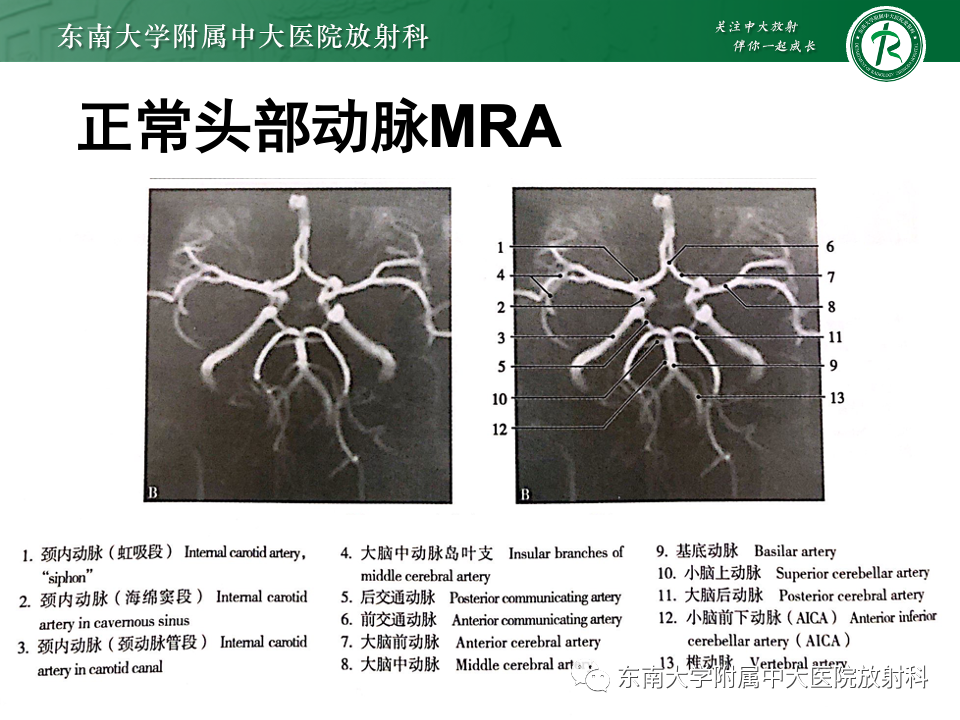 影像PPT - 【PPT】永存颈内—基底动脉吻合-12