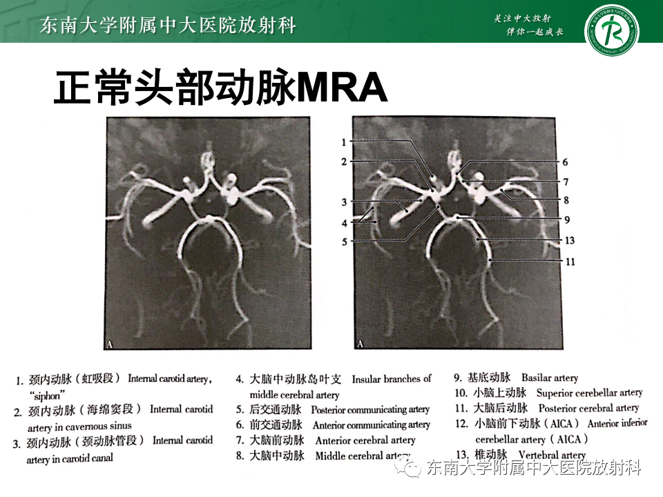 影像PPT - 【PPT】永存颈内—基底动脉吻合-13