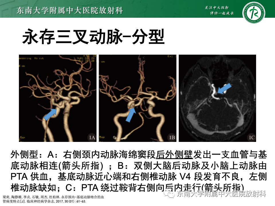 影像PPT - 【PPT】永存颈内—基底动脉吻合-16