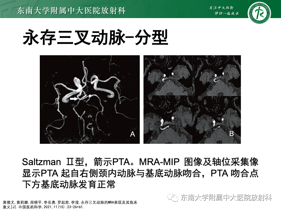 影像PPT - 【PPT】永存颈内—基底动脉吻合-21