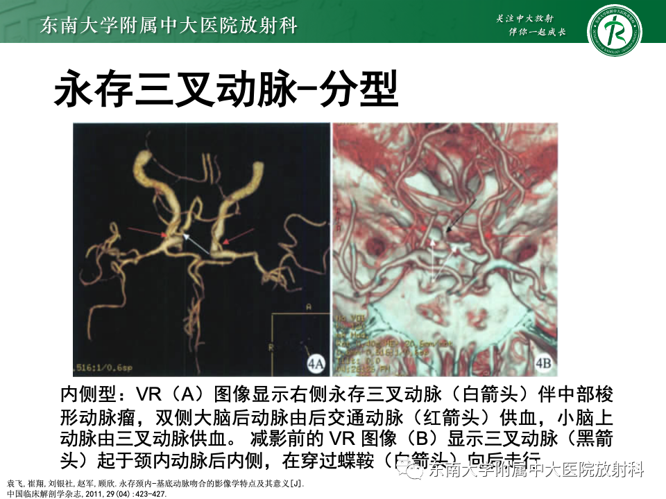 影像PPT - 【PPT】永存颈内—基底动脉吻合-17