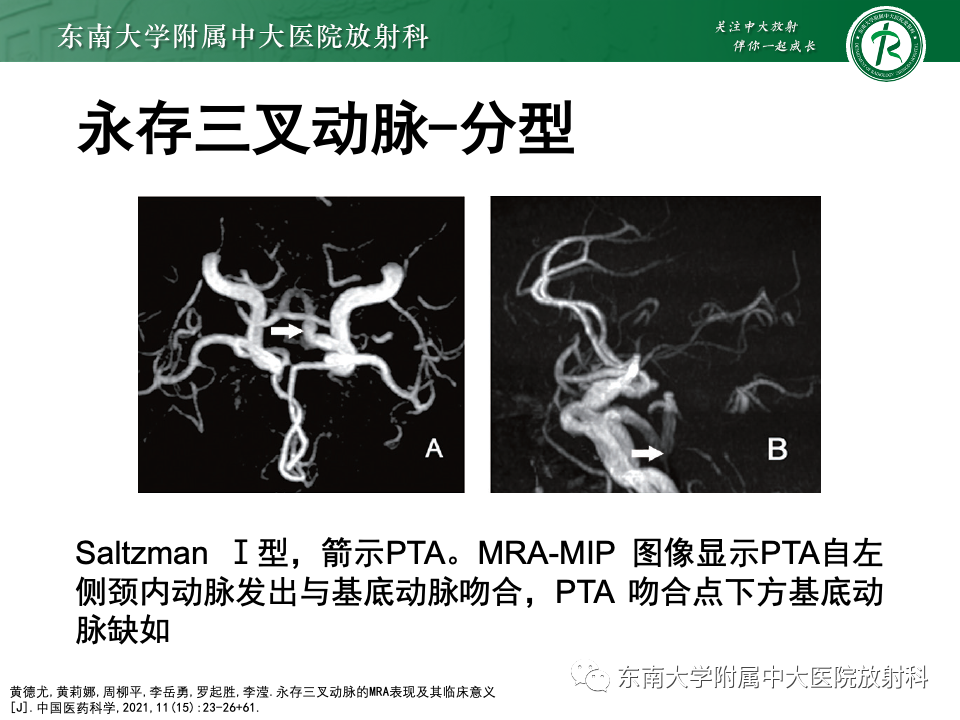 影像PPT - 【PPT】永存颈内—基底动脉吻合-19