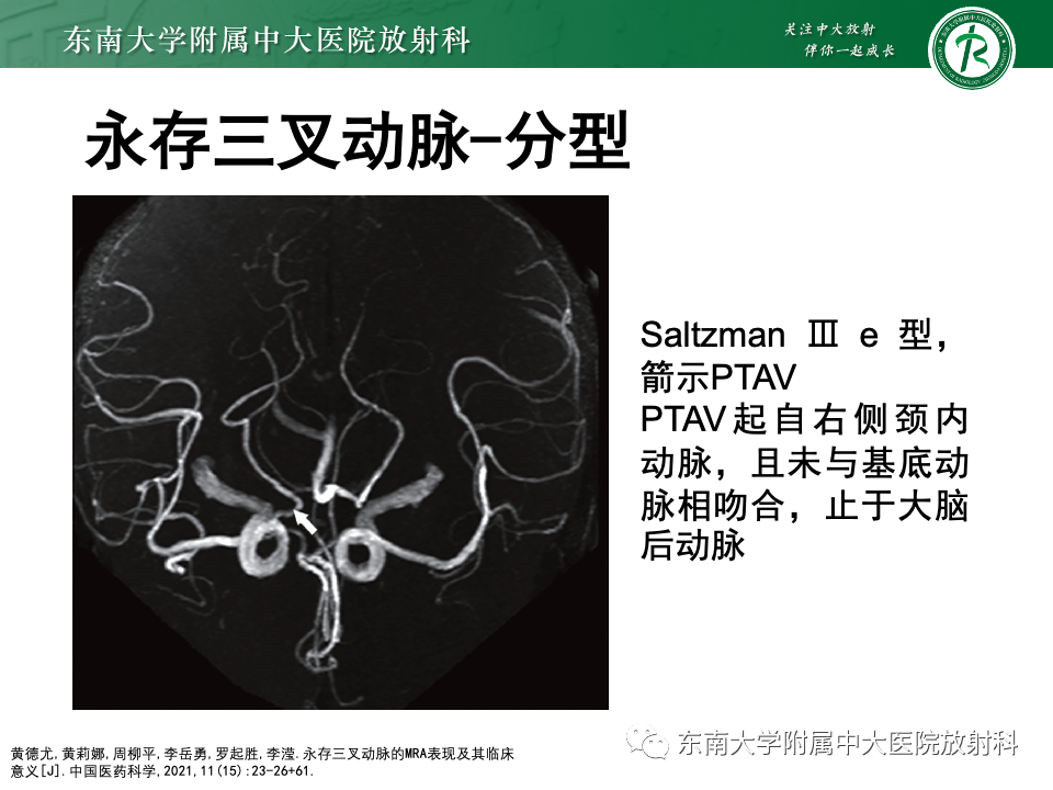影像PPT - 【PPT】永存颈内—基底动脉吻合-23