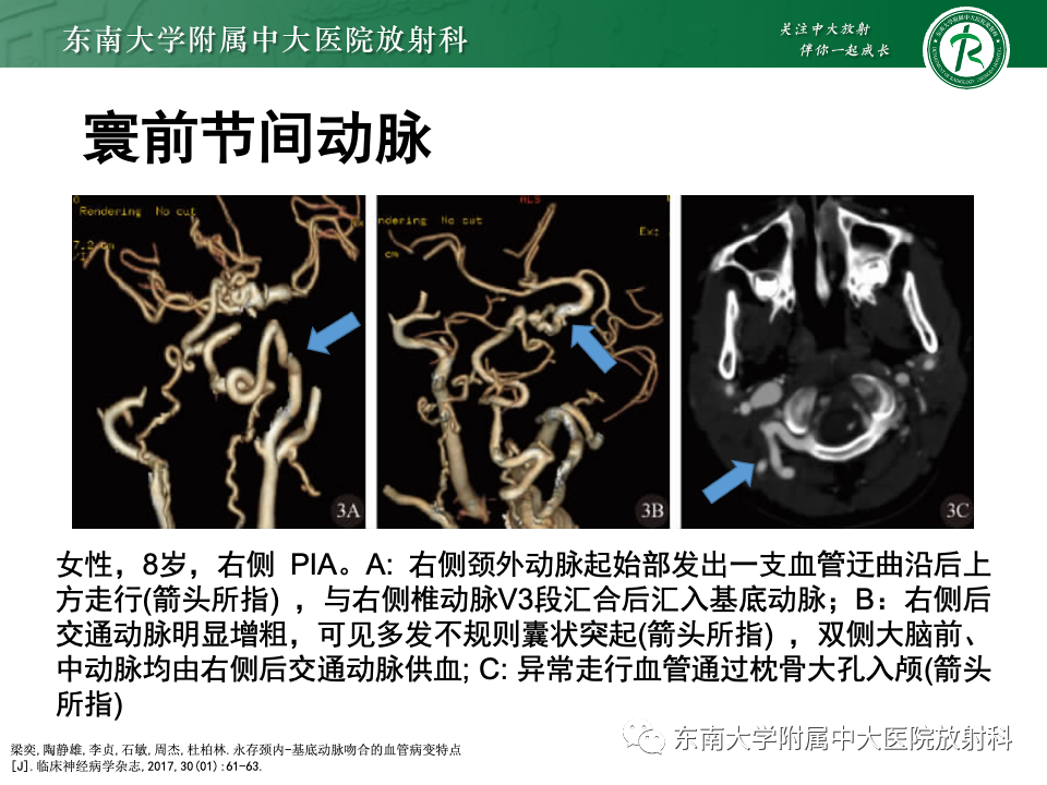 影像PPT - 【PPT】永存颈内—基底动脉吻合-27