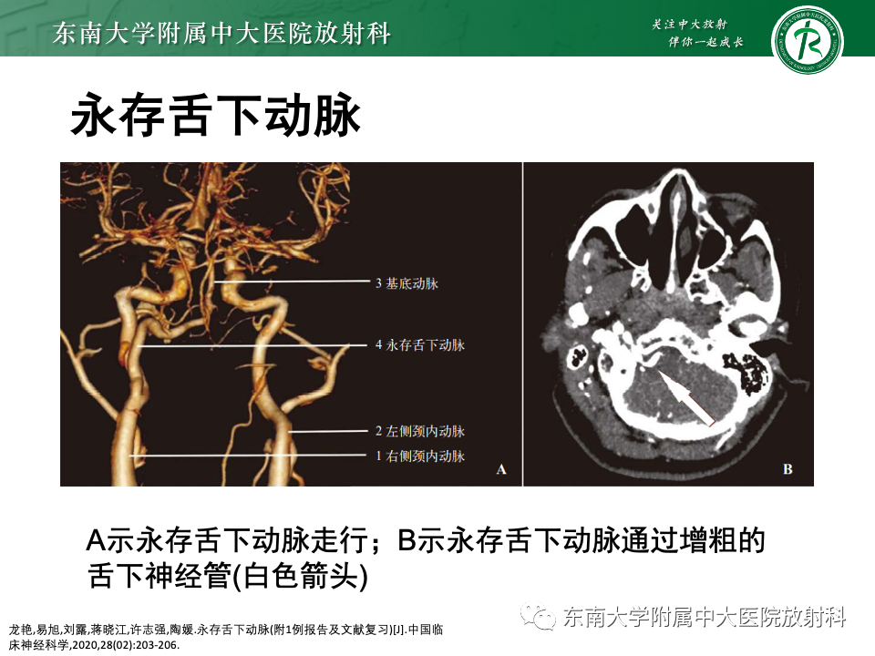 影像PPT - 【PPT】永存颈内—基底动脉吻合-25