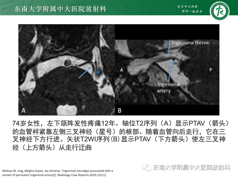 影像PPT - 【PPT】永存颈内—基底动脉吻合-29