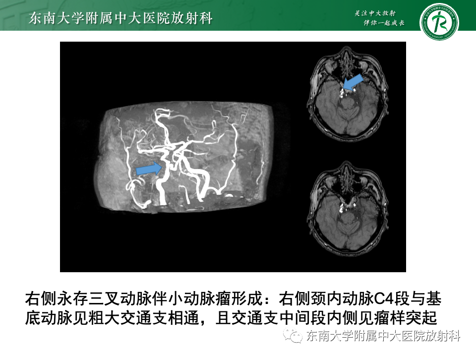 影像PPT - 【PPT】永存颈内—基底动脉吻合-34