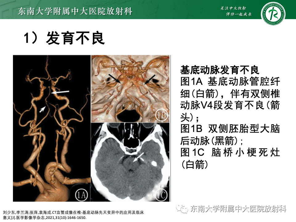 影像PPT - 【PPT】永存颈内—基底动脉吻合-36