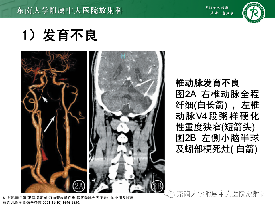 影像PPT - 【PPT】永存颈内—基底动脉吻合-37