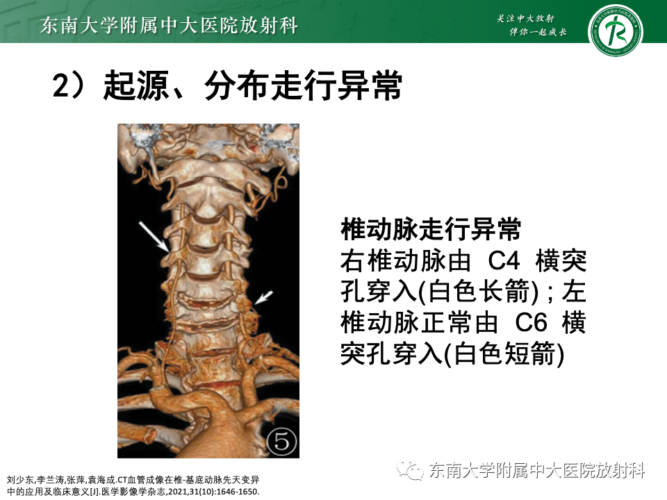 影像PPT - 【PPT】永存颈内—基底动脉吻合-39