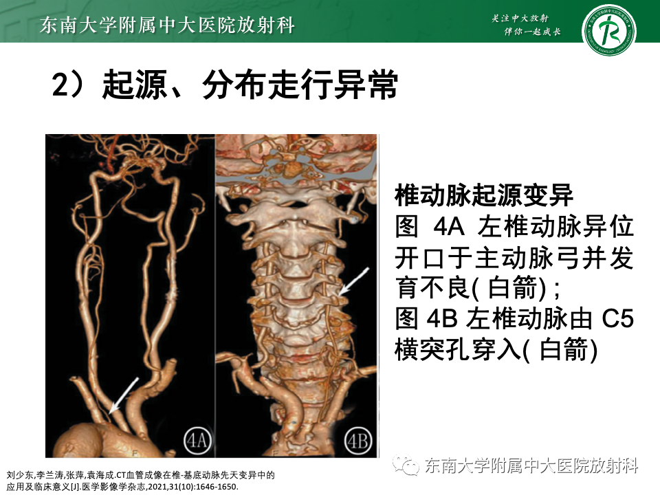 影像PPT - 【PPT】永存颈内—基底动脉吻合-38