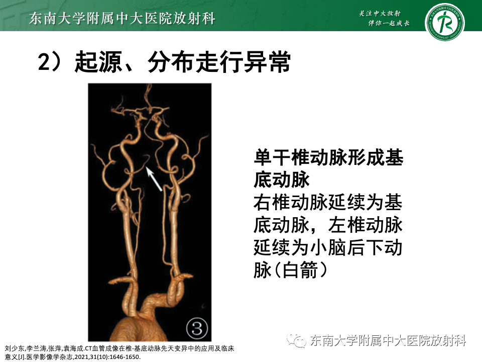 影像PPT - 【PPT】永存颈内—基底动脉吻合-40