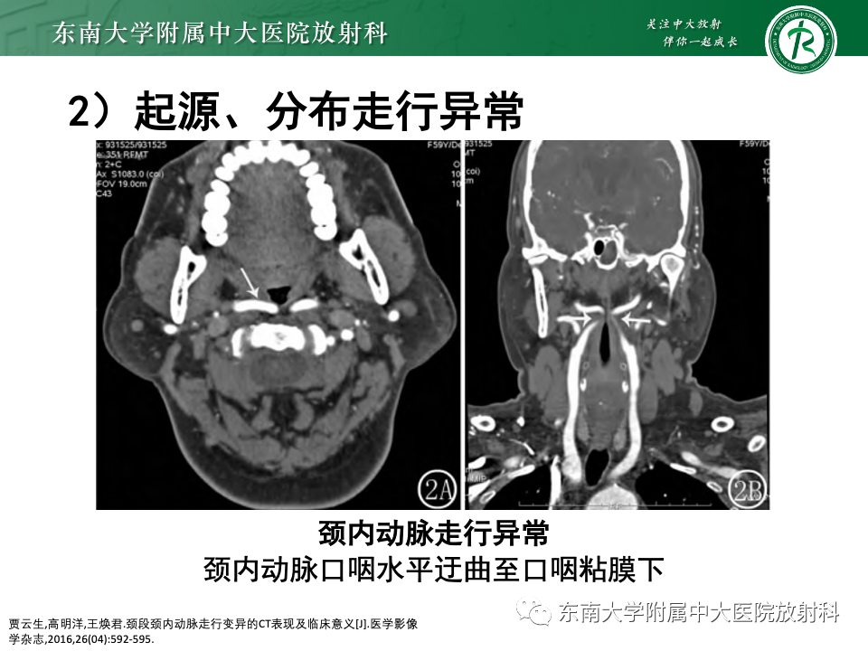 影像PPT - 【PPT】永存颈内—基底动脉吻合-41