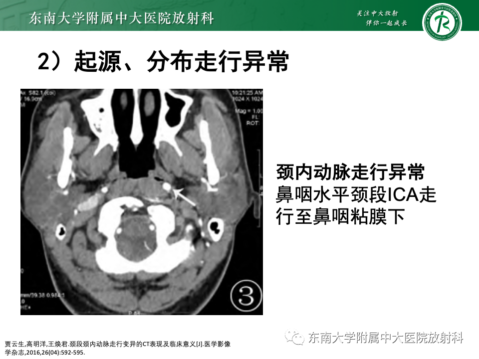 影像PPT - 【PPT】永存颈内—基底动脉吻合-42
