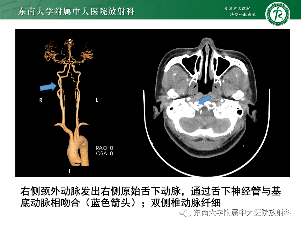 影像PPT - 【PPT】永存颈内—基底动脉吻合-44