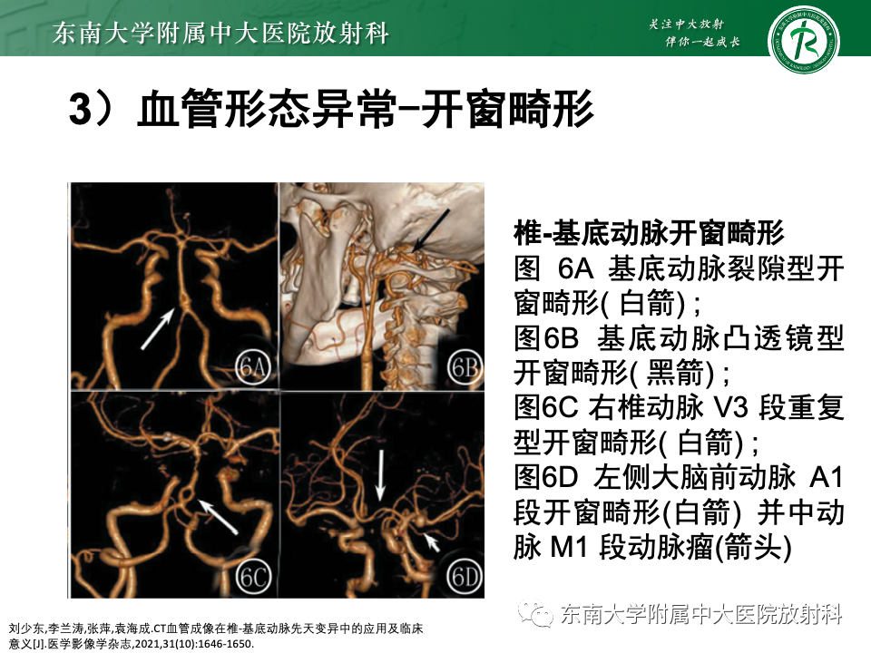 影像PPT - 【PPT】永存颈内—基底动脉吻合-46
