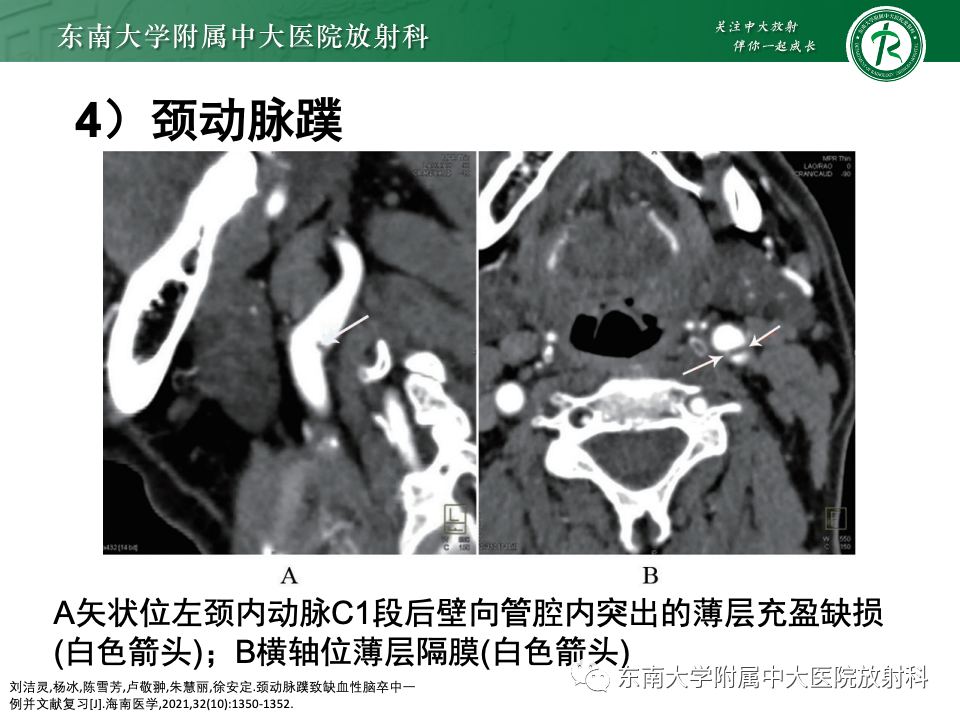 影像PPT - 【PPT】永存颈内—基底动脉吻合-48