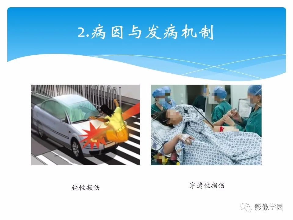 影像PPT - 【PPT】常见腹部外伤的影像诊断-6