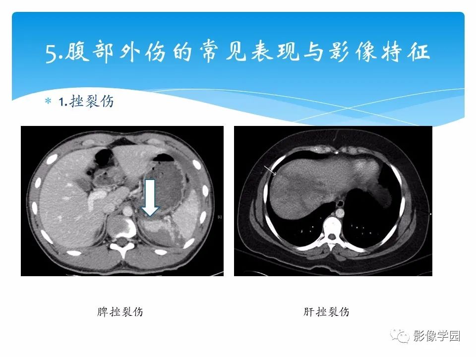 影像PPT - 【PPT】常见腹部外伤的影像诊断-18