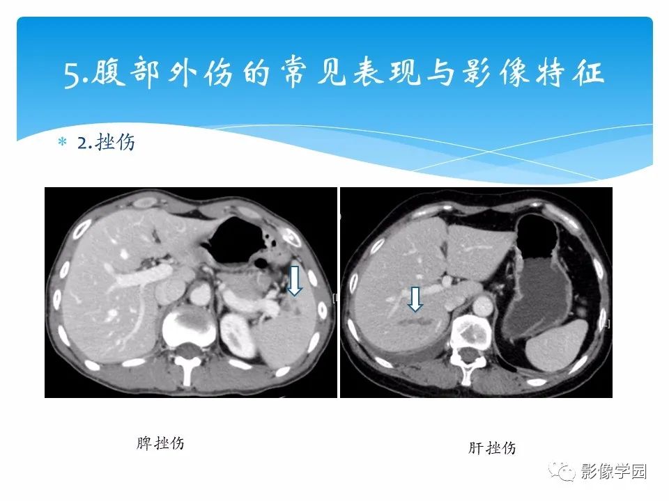 影像PPT - 【PPT】常见腹部外伤的影像诊断-20