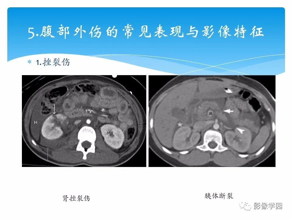 影像PPT - 【PPT】常见腹部外伤的影像诊断-19