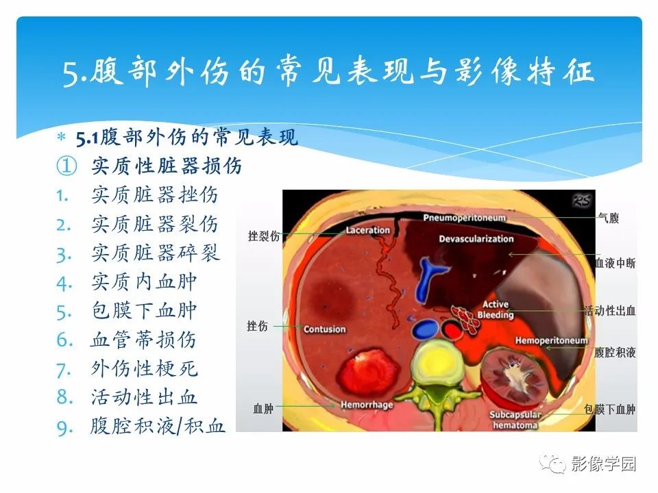 影像PPT - 【PPT】常见腹部外伤的影像诊断-17