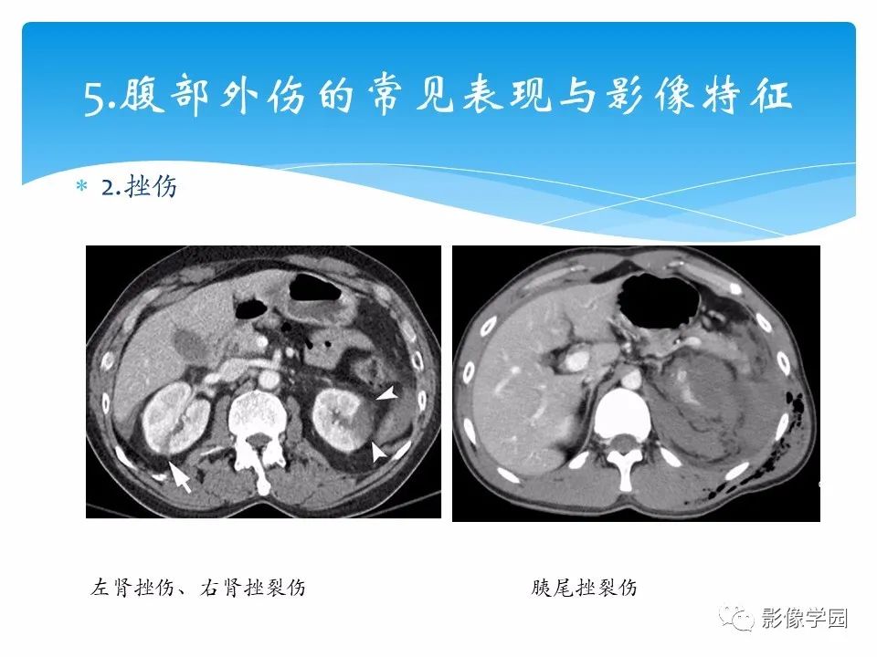 影像PPT - 【PPT】常见腹部外伤的影像诊断-21
