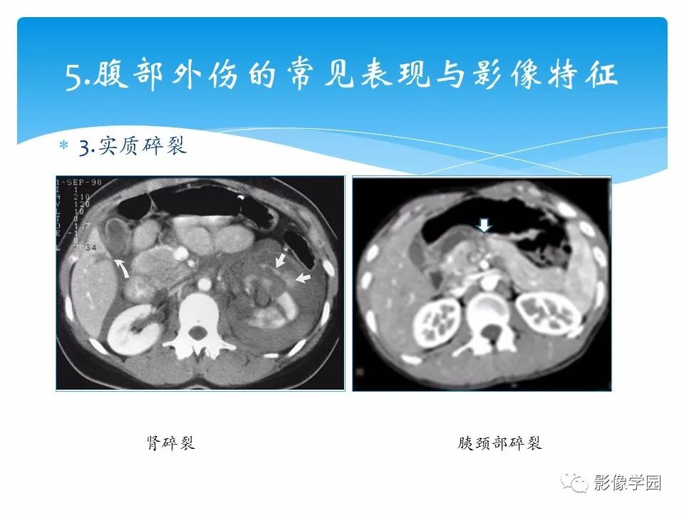 影像PPT - 【PPT】常见腹部外伤的影像诊断-23