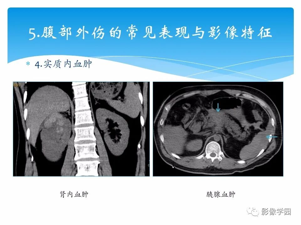 影像PPT - 【PPT】常见腹部外伤的影像诊断-25