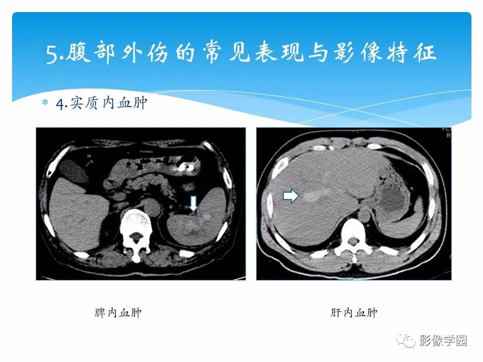 影像PPT - 【PPT】常见腹部外伤的影像诊断-24