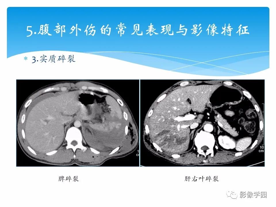 影像PPT - 【PPT】常见腹部外伤的影像诊断-22