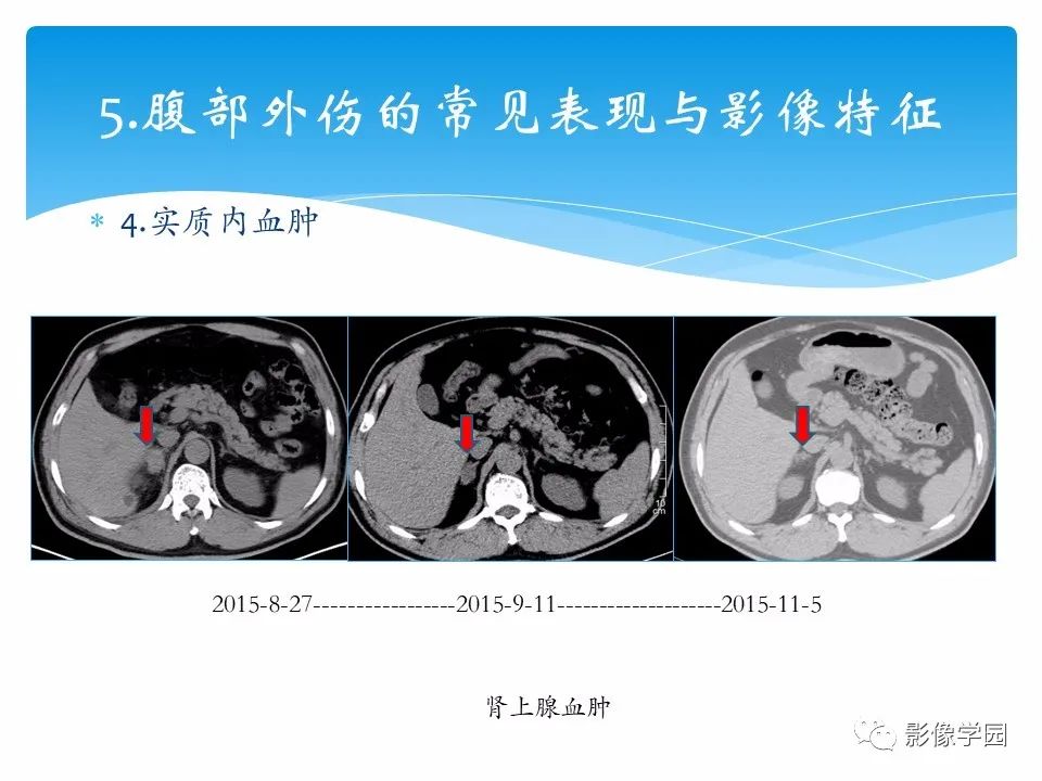 影像PPT - 【PPT】常见腹部外伤的影像诊断-26