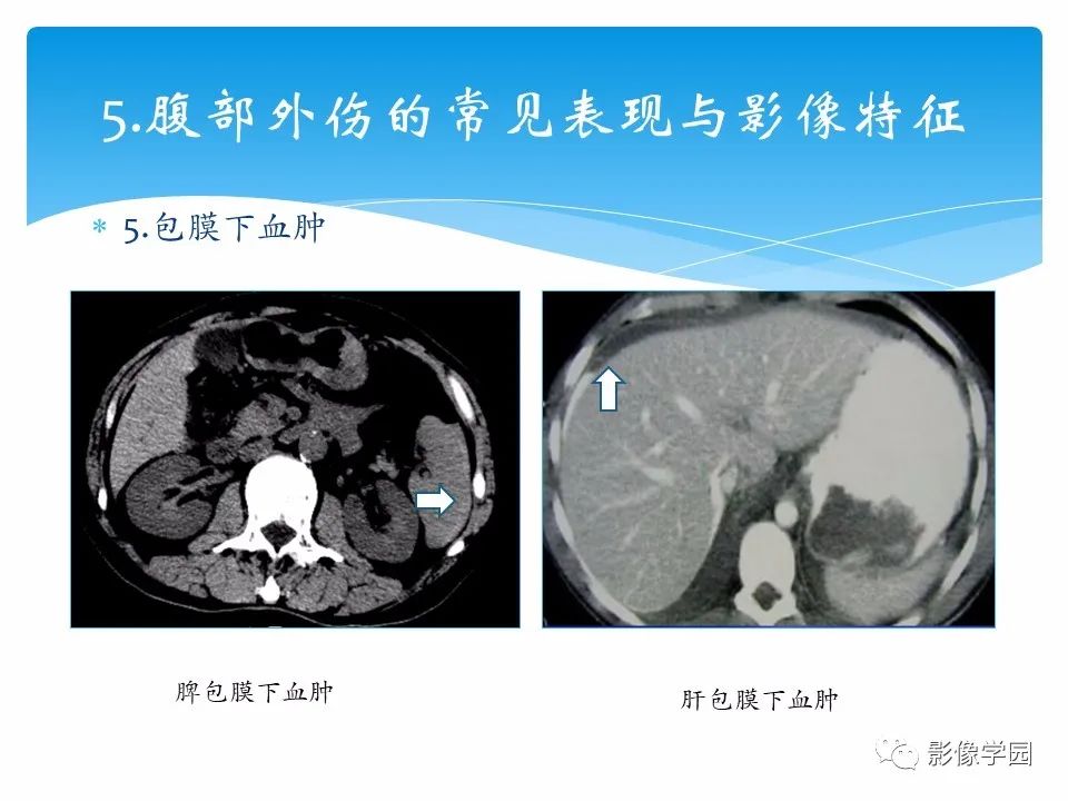 影像PPT - 【PPT】常见腹部外伤的影像诊断-27
