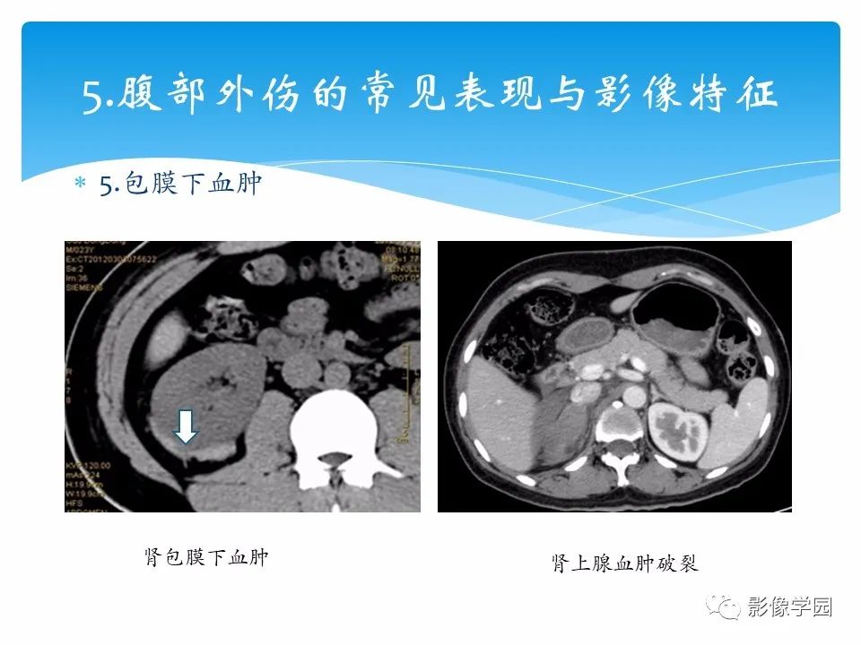 影像PPT - 【PPT】常见腹部外伤的影像诊断-28