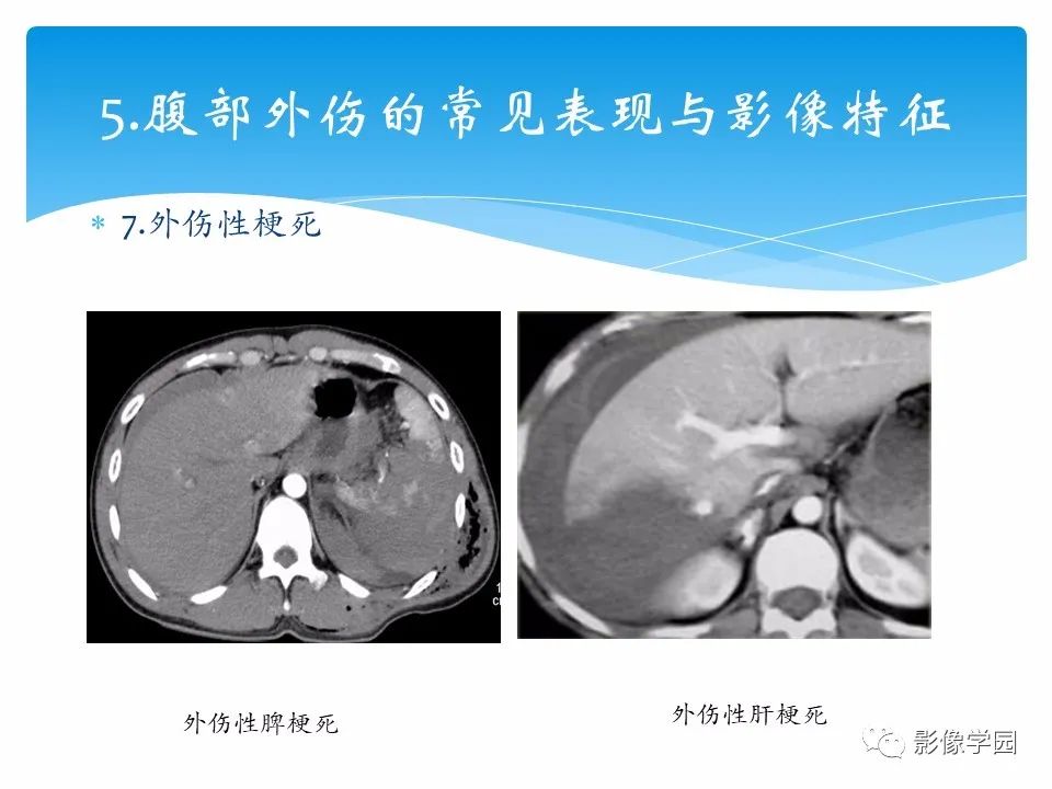 影像PPT - 【PPT】常见腹部外伤的影像诊断-31