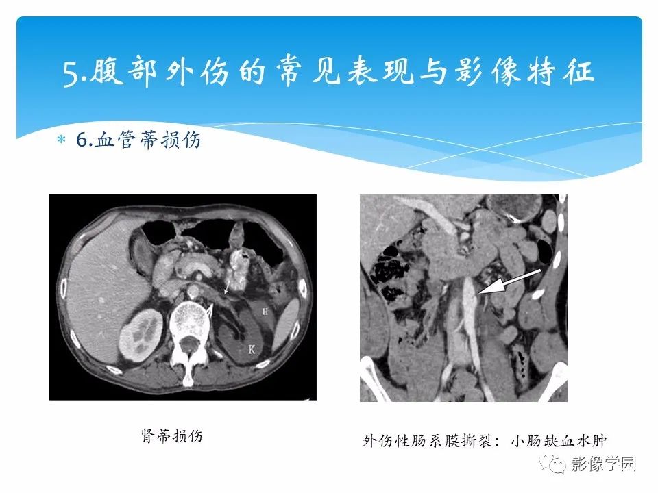 影像PPT - 【PPT】常见腹部外伤的影像诊断-30