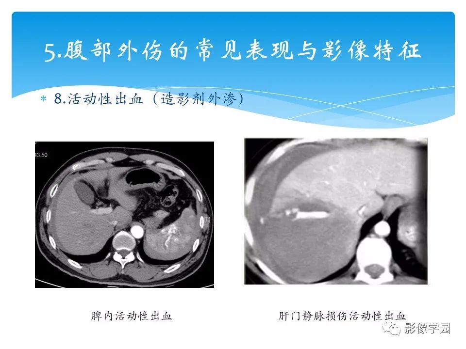 影像PPT - 【PPT】常见腹部外伤的影像诊断-32