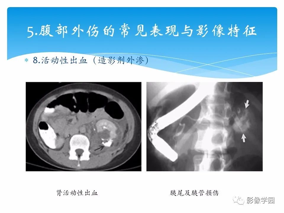影像PPT - 【PPT】常见腹部外伤的影像诊断-33