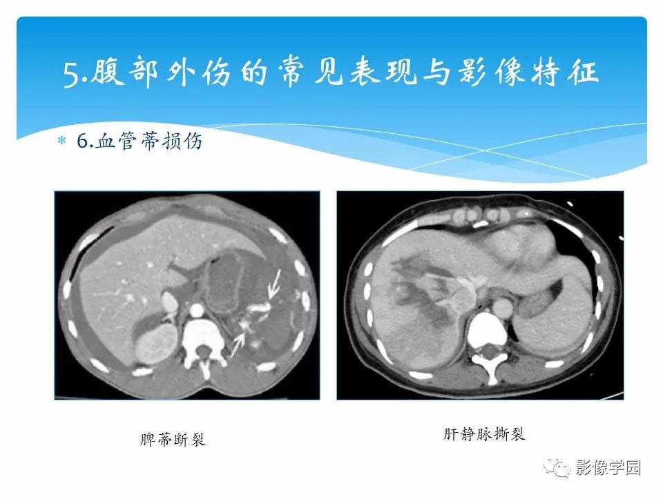 影像PPT - 【PPT】常见腹部外伤的影像诊断-29