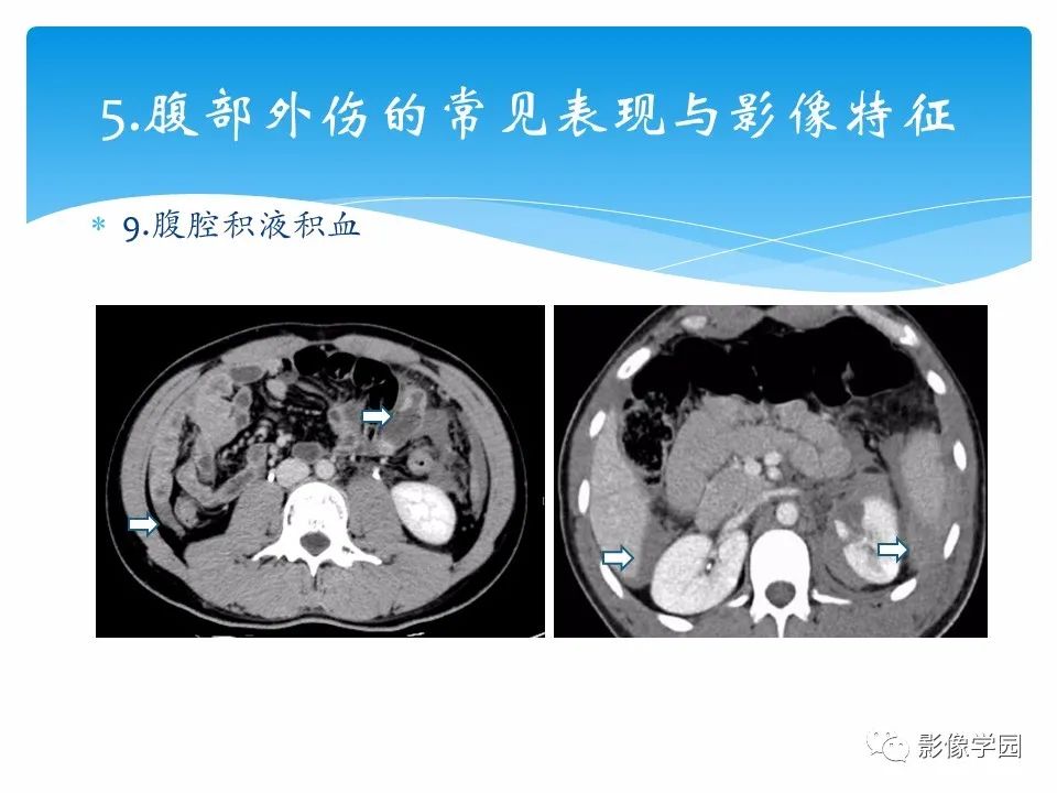 影像PPT - 【PPT】常见腹部外伤的影像诊断-34