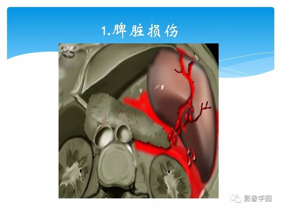 影像PPT - 【PPT】常见腹部外伤的影像诊断-36