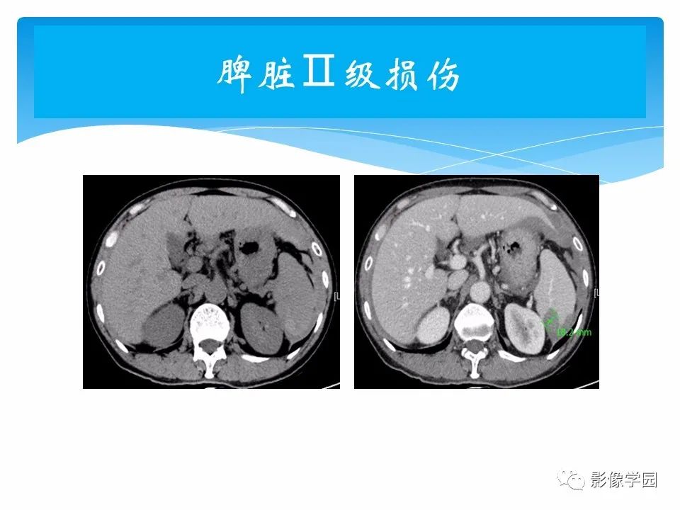 影像PPT - 【PPT】常见腹部外伤的影像诊断-39