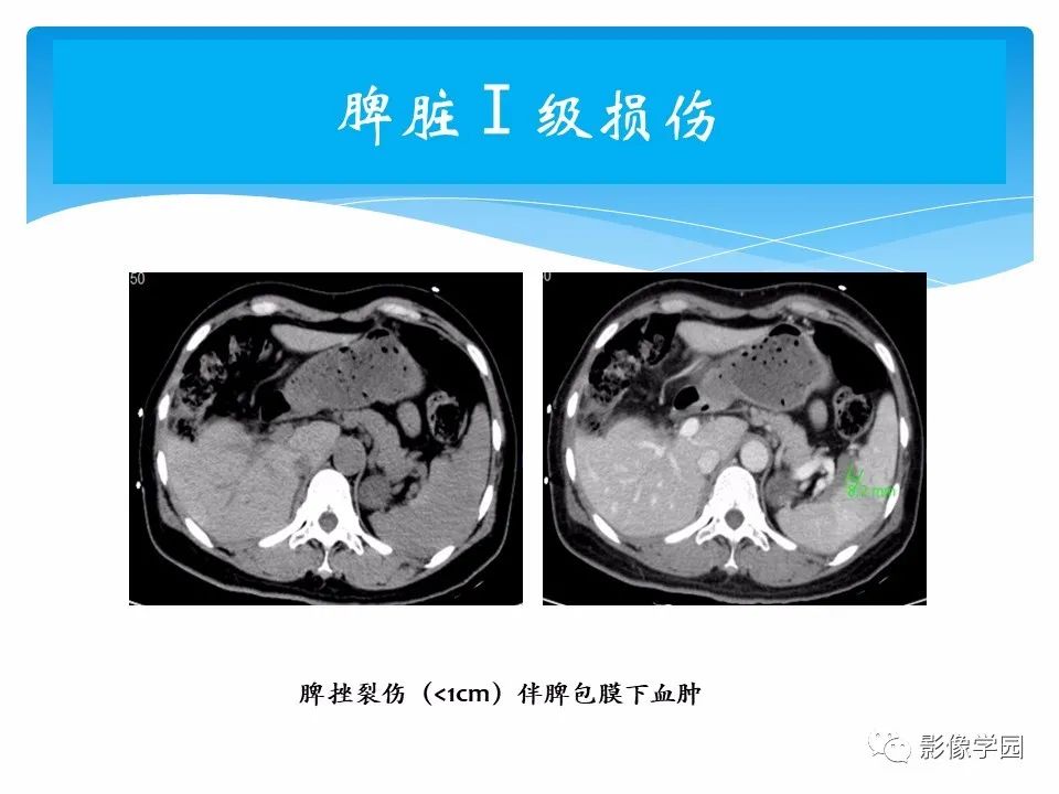 影像PPT - 【PPT】常见腹部外伤的影像诊断-38