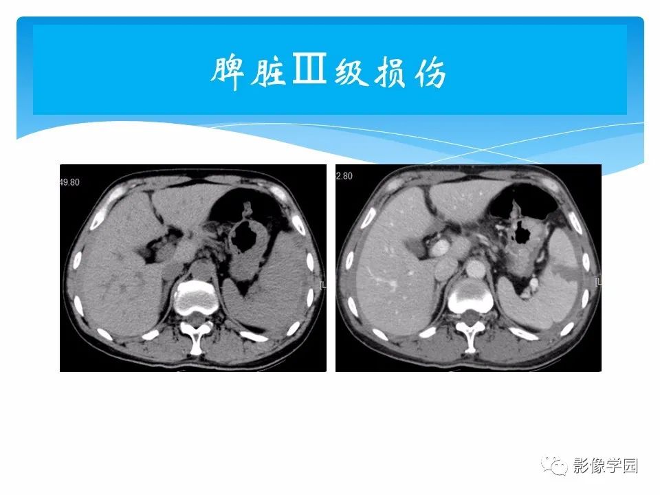 影像PPT - 【PPT】常见腹部外伤的影像诊断-40