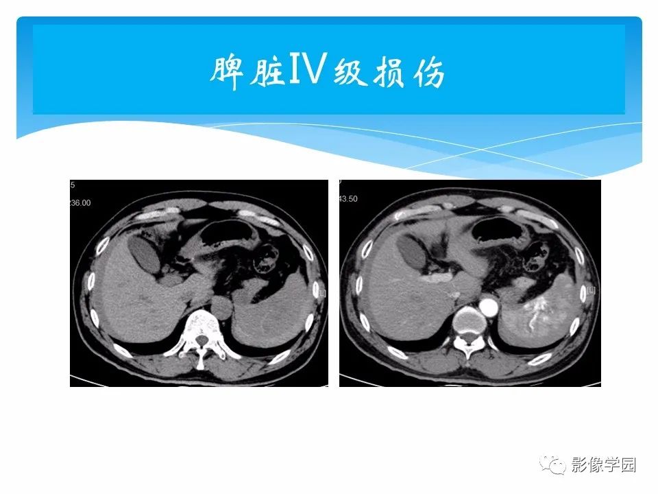 影像PPT - 【PPT】常见腹部外伤的影像诊断-41